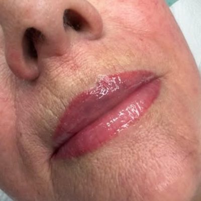 before and after dark lip neutralisation