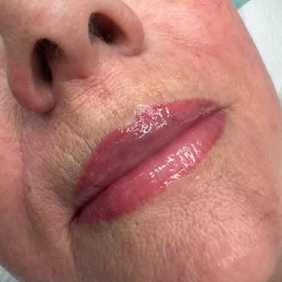 before and after dark lip neutralisation
