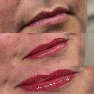 before and after lip filler migration