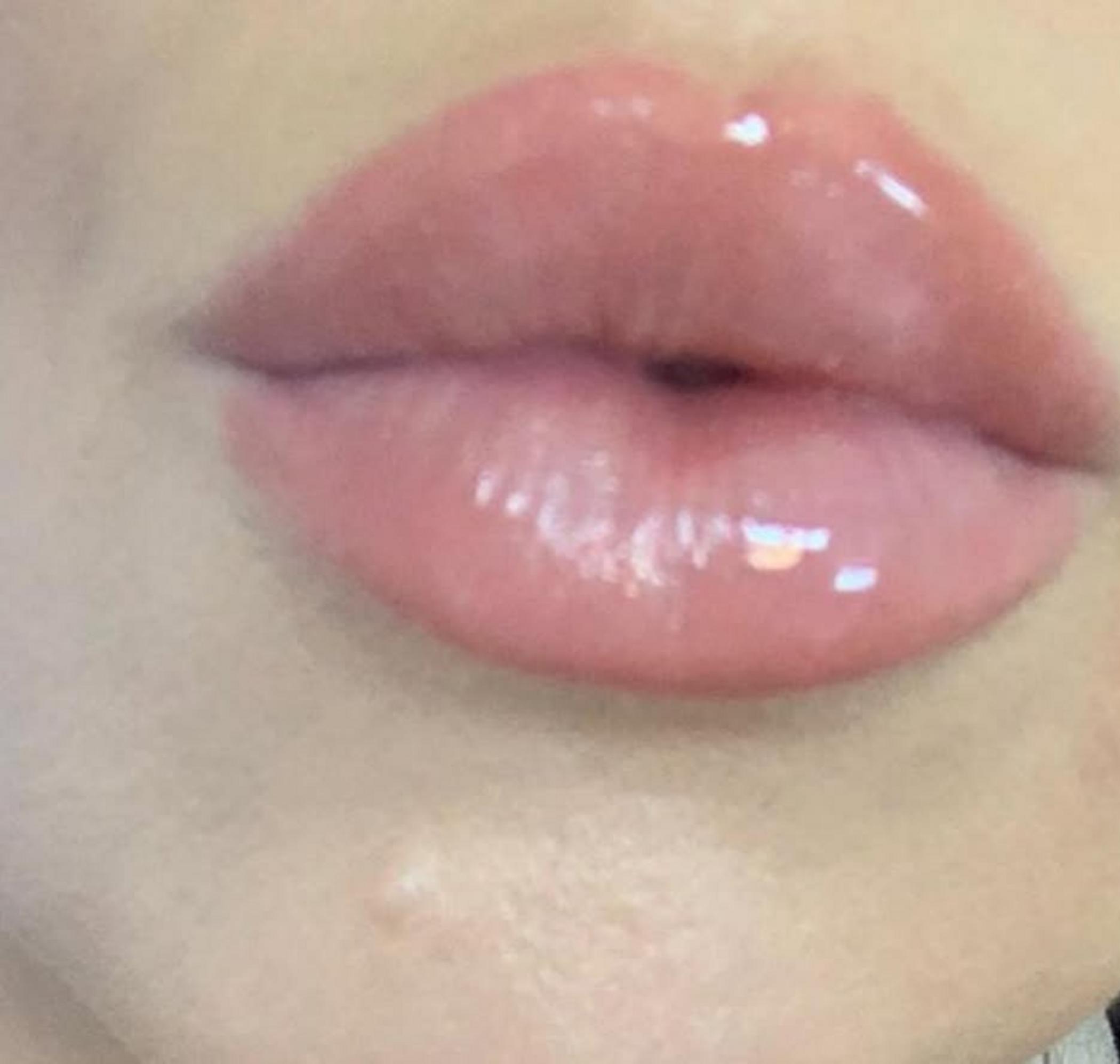flaking stage lips healing process