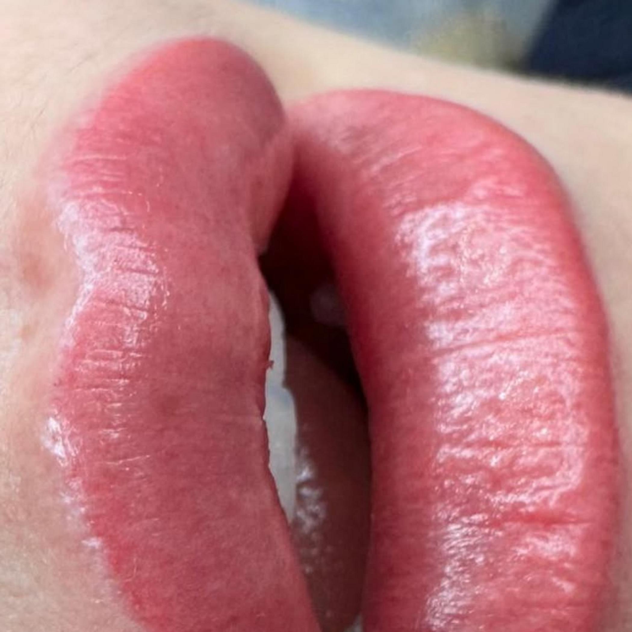 healing phase scabbed lips close