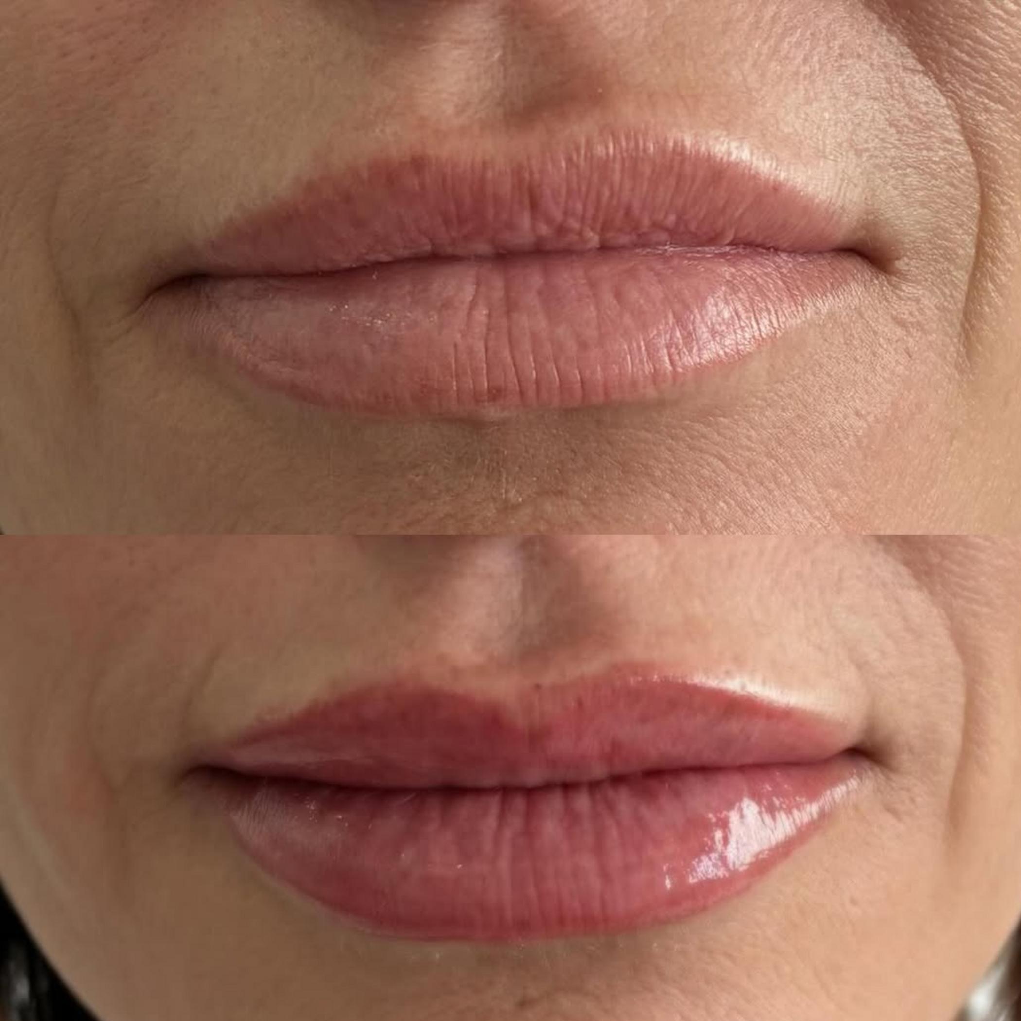 technician working on lip blush procedure